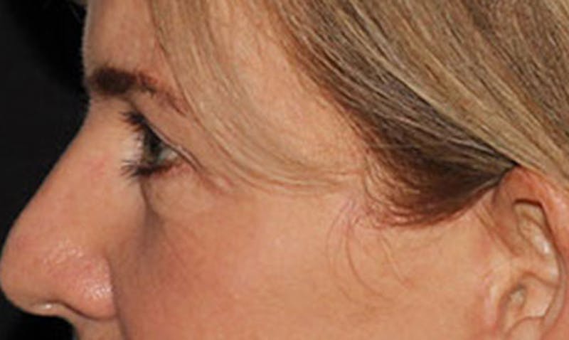 Laser Resurfacing Before & After Gallery - Patient 133024122 - Image 8