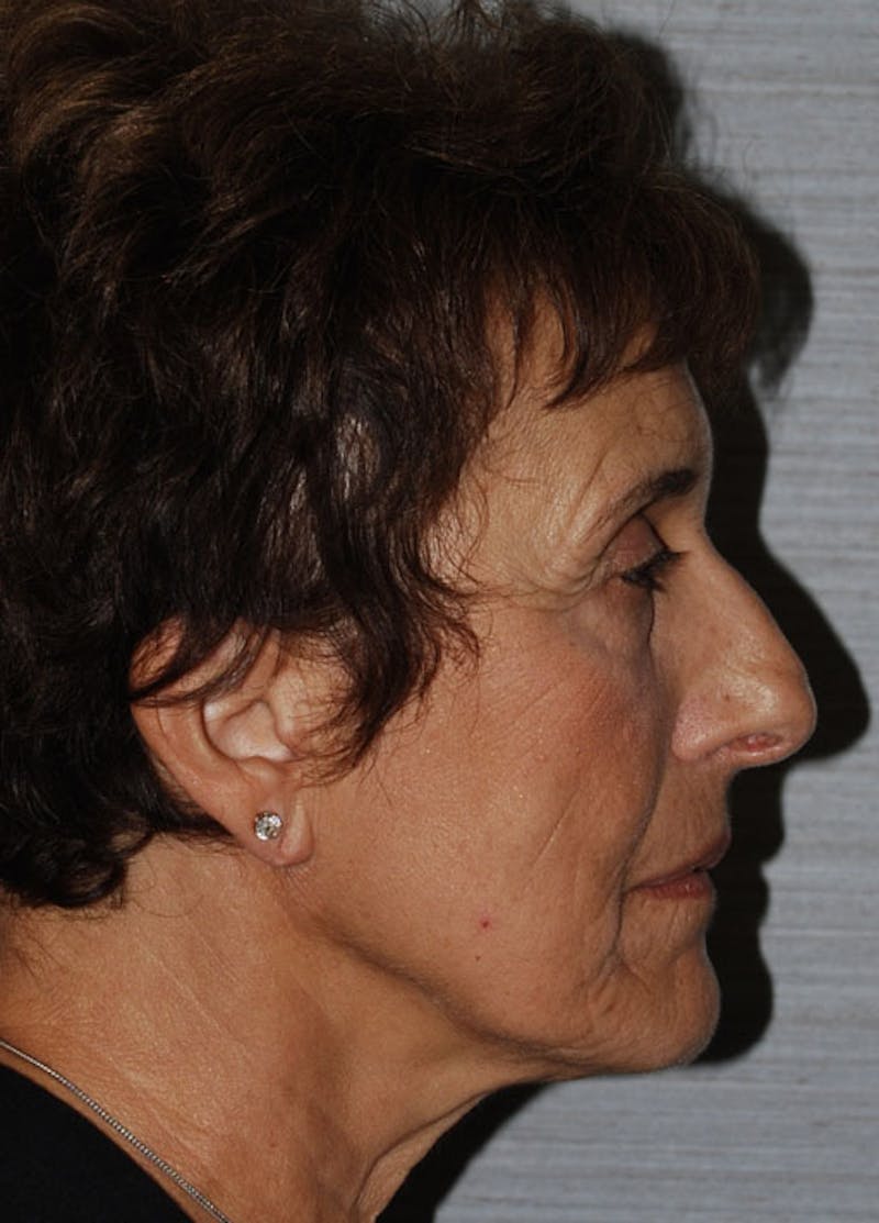 Facelift & Necklift Before & After Gallery - Patient 133024121 - Image 5