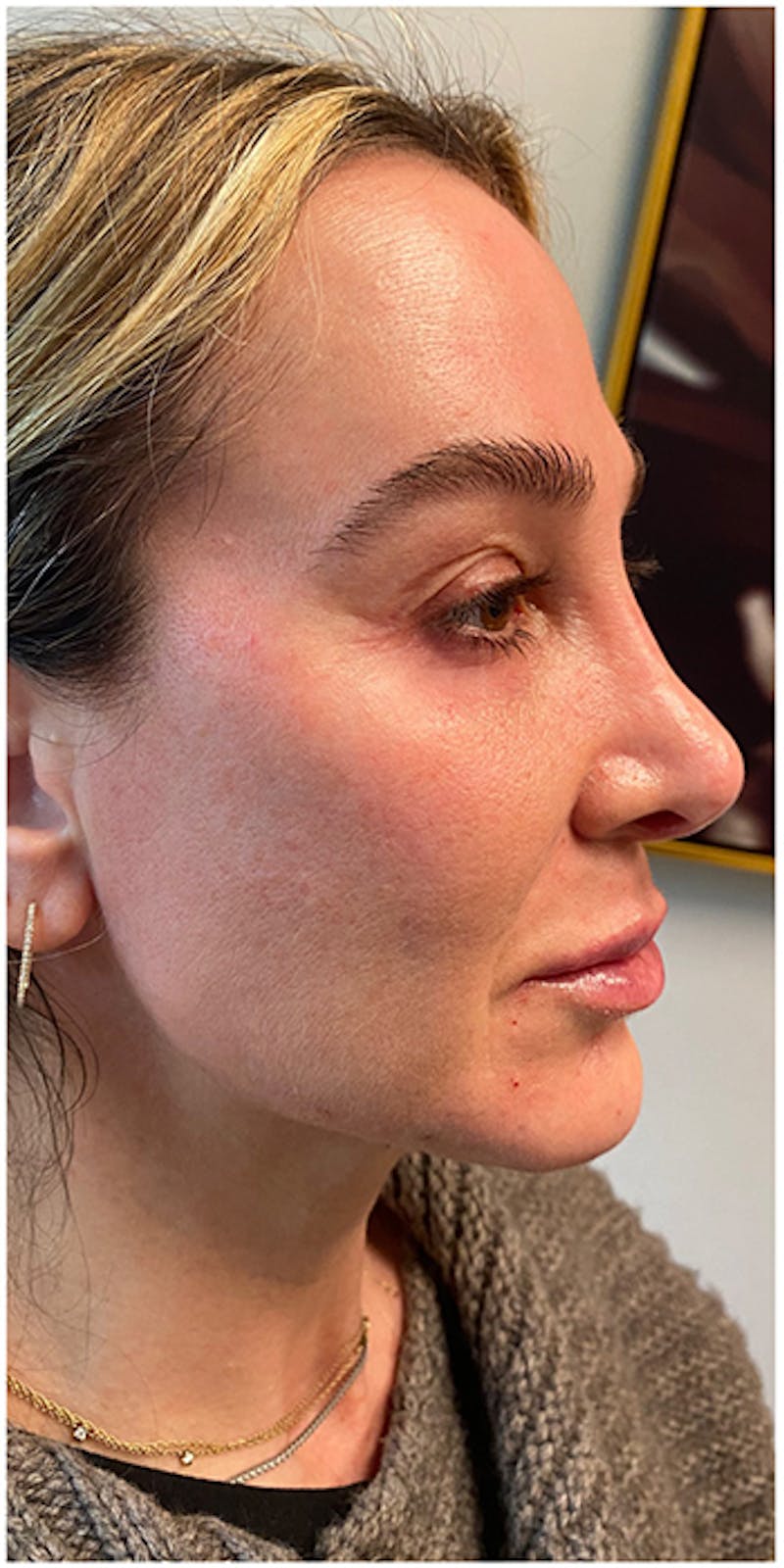 Dermal Fillers Before & After Gallery - Patient 133024123 - Image 8