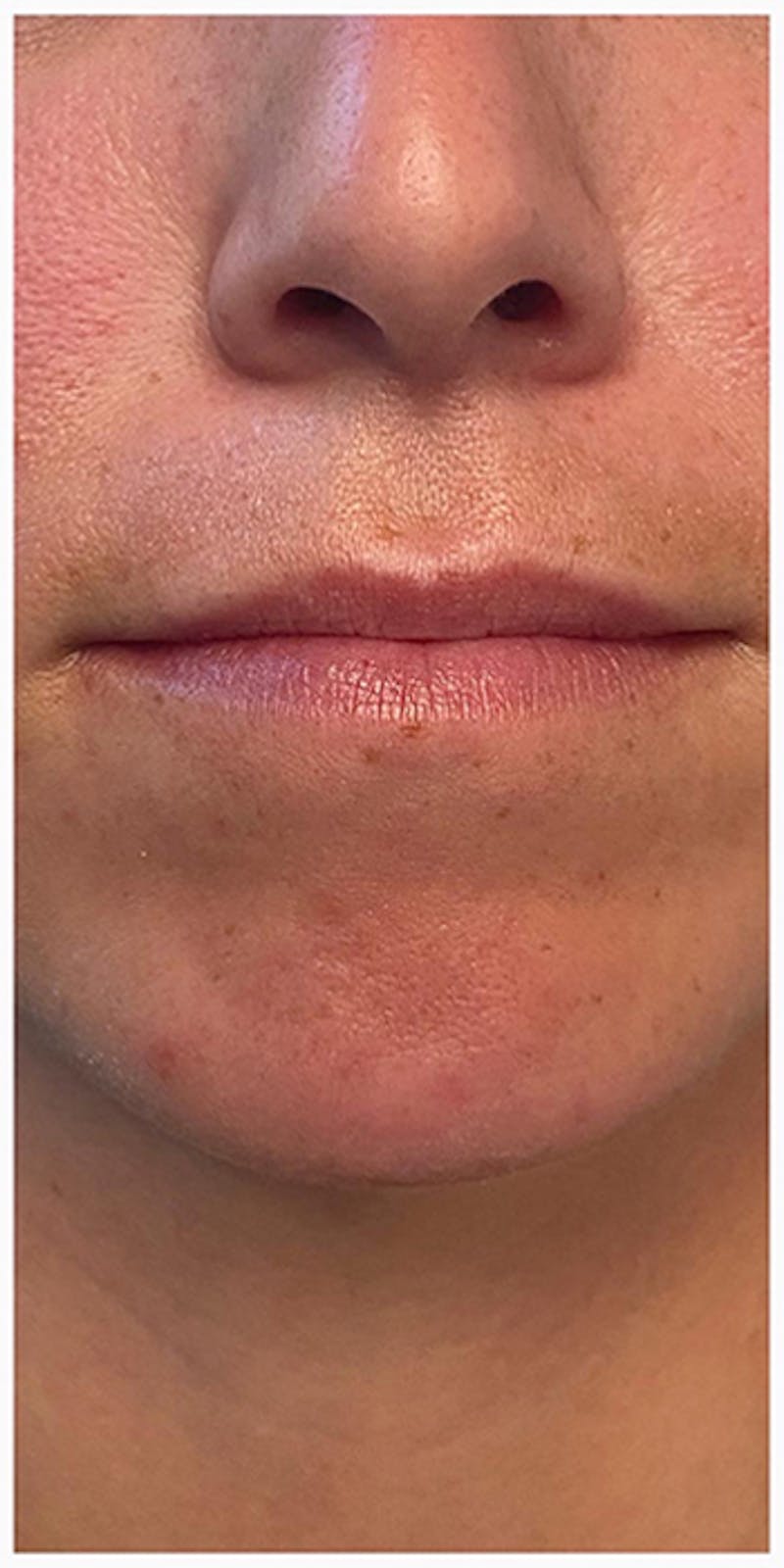 Lip Enhancement Before & After Gallery - Patient 133024127 - Image 5