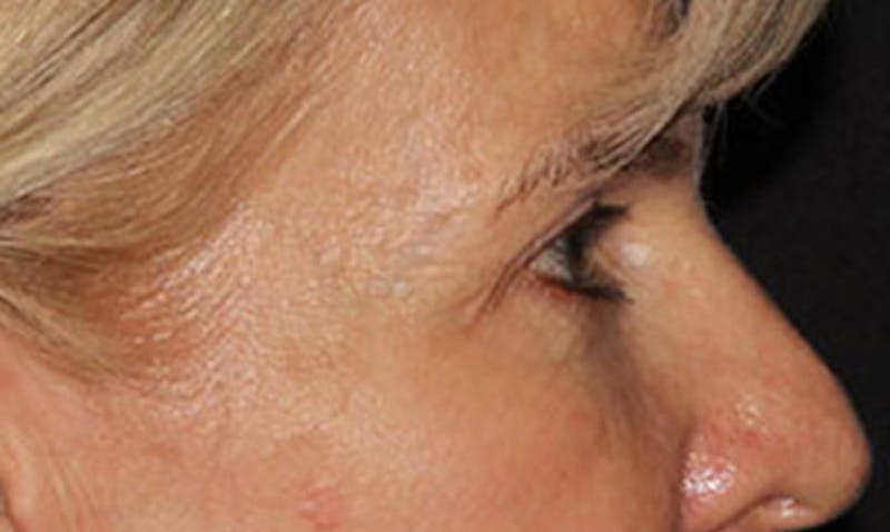 Laser Resurfacing Before & After Gallery - Patient 133024122 - Image 9