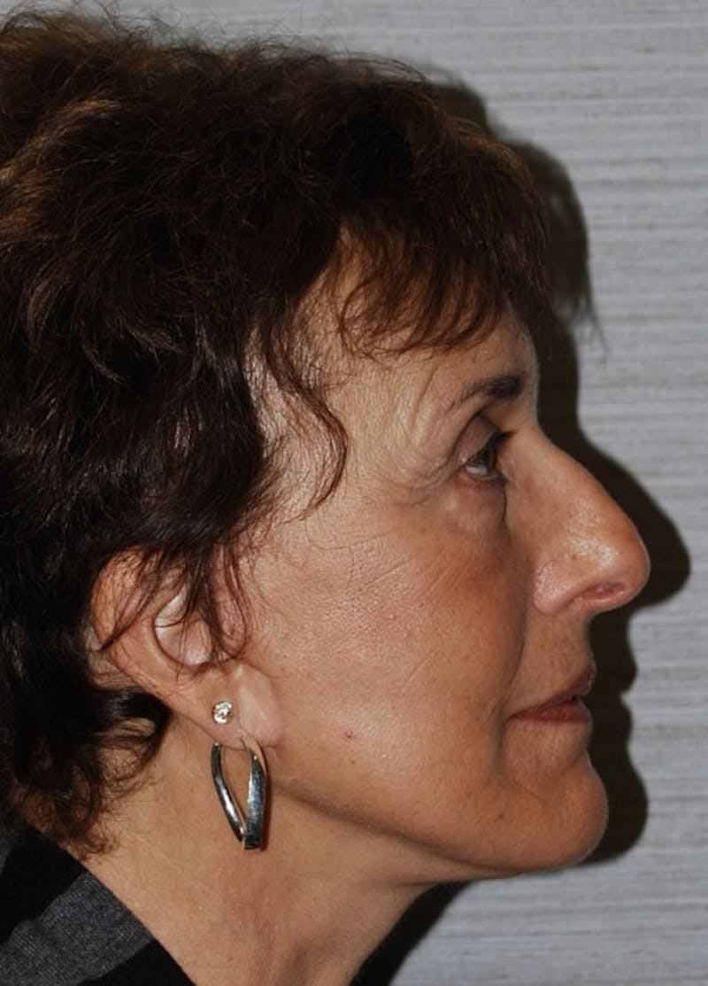 Facelift & Necklift Before & After Gallery - Patient 133024121 - Image 6