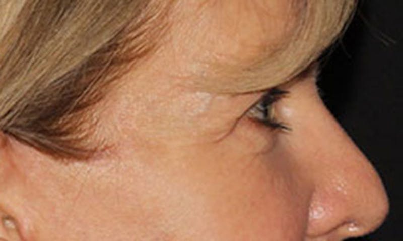 Laser Resurfacing Before & After Gallery - Patient 133024122 - Image 10
