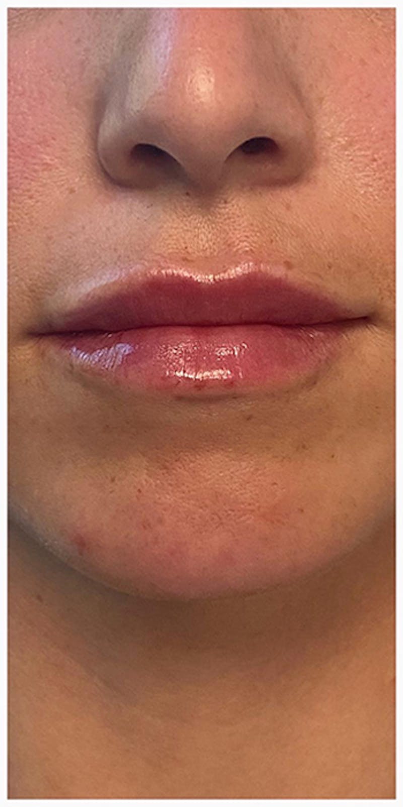 Lip Enhancement Before & After Gallery - Patient 133024127 - Image 6