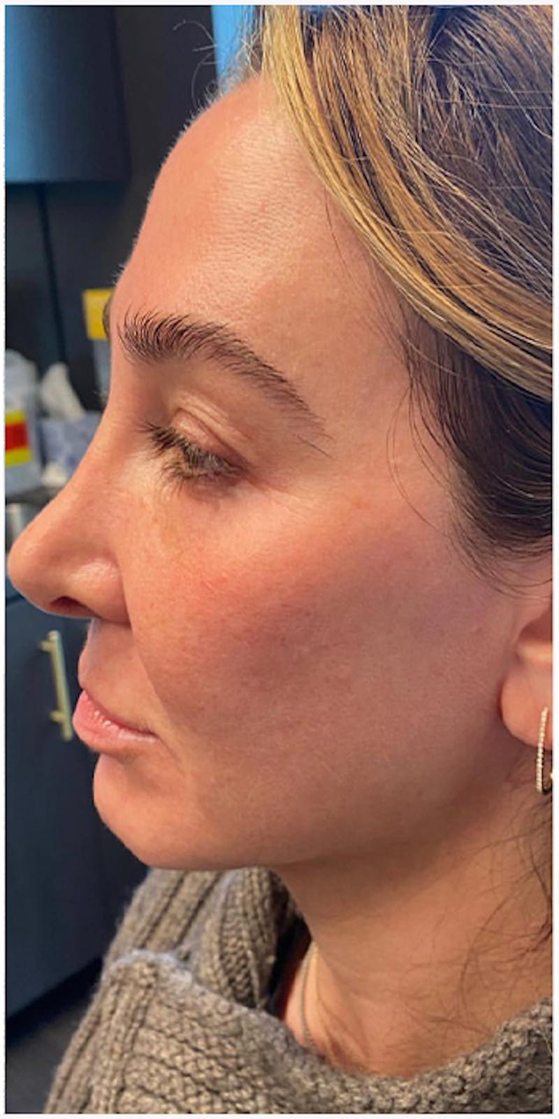 Dermal Fillers Before & After Gallery - Patient 133024123 - Image 9
