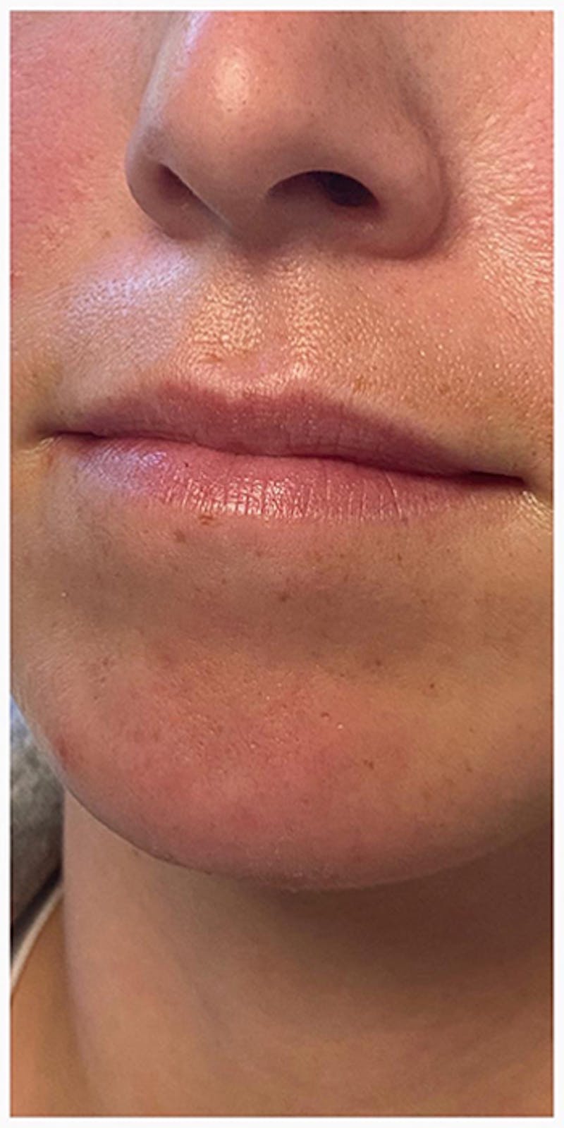 Lip Enhancement Before & After Gallery - Patient 133024127 - Image 7