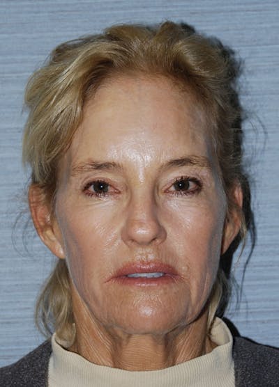 Facelift & Necklift Before & After Gallery - Patient 133024126 - Image 1