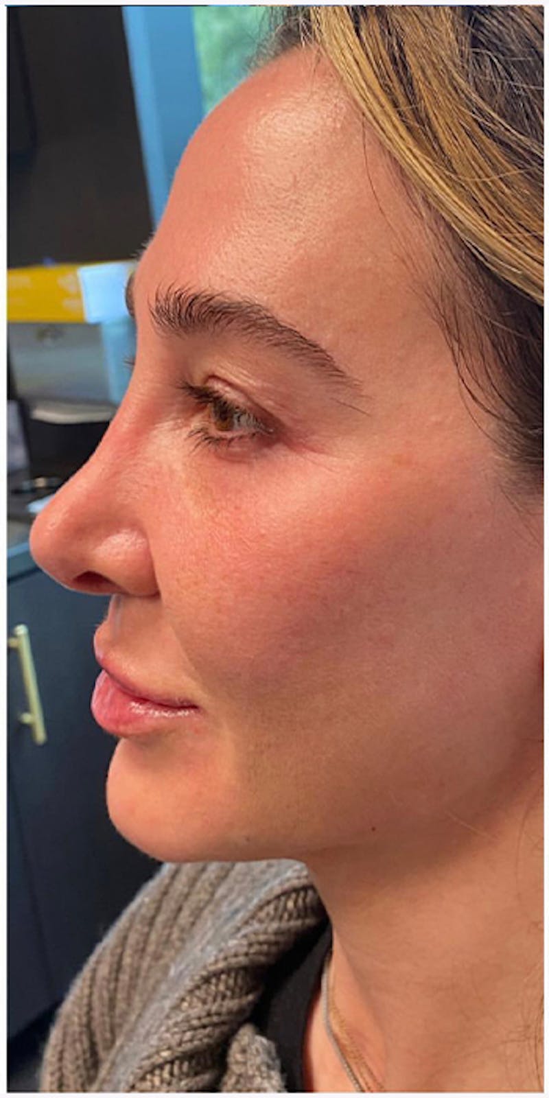 Dermal Fillers Before & After Gallery - Patient 133024123 - Image 10