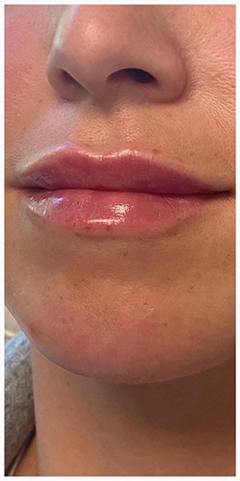 Lip Enhancement Before & After Gallery - Patient 133024127 - Image 8