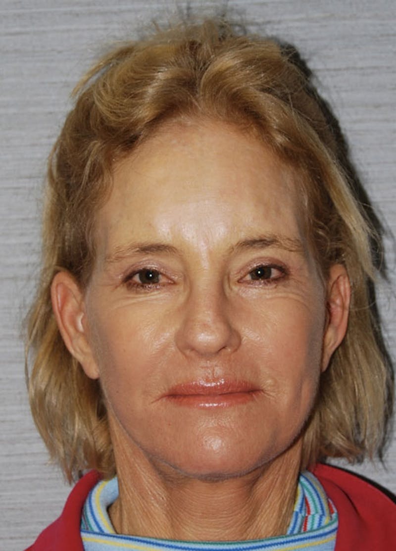Facelift & Necklift Before & After Gallery - Patient 133024126 - Image 2