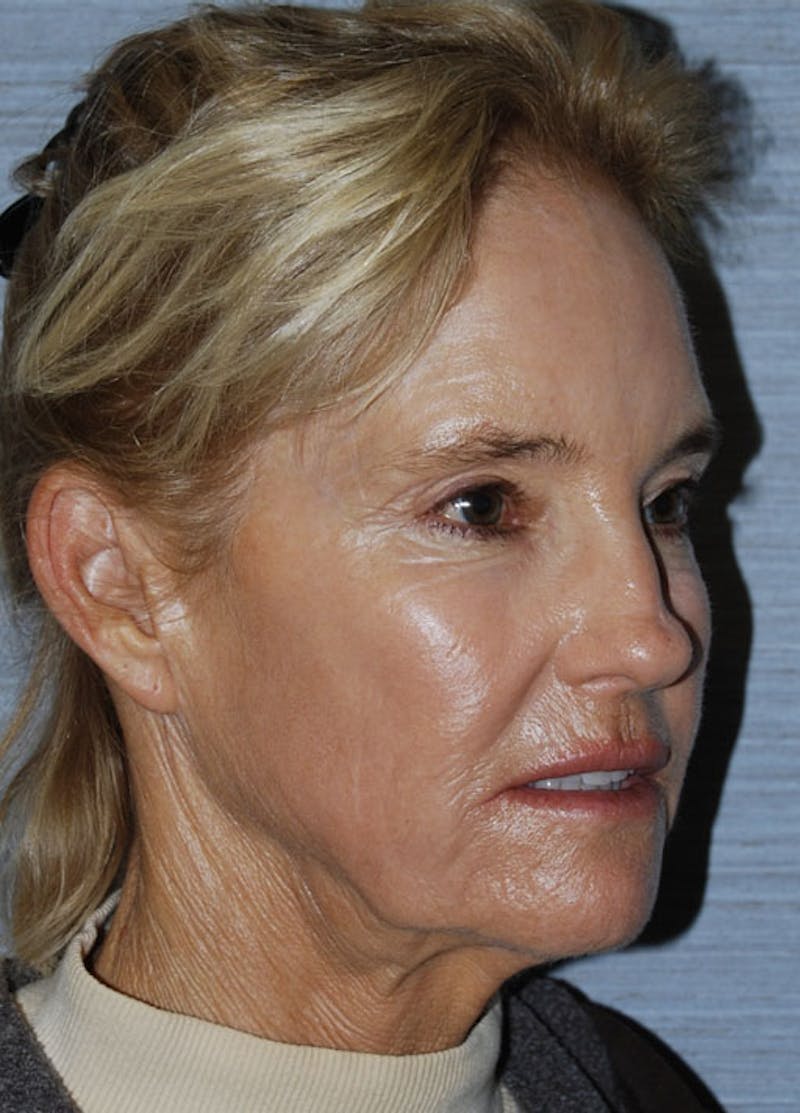 Facelift & Necklift Before & After Gallery - Patient 133024126 - Image 3