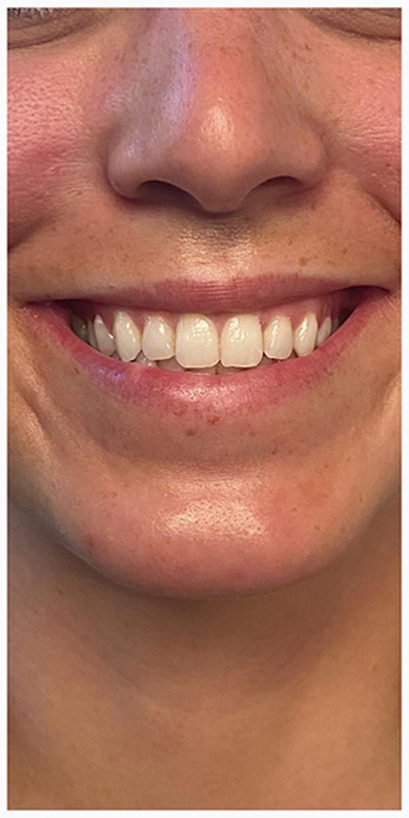 Lip Enhancement Before & After Gallery - Patient 133024127 - Image 9
