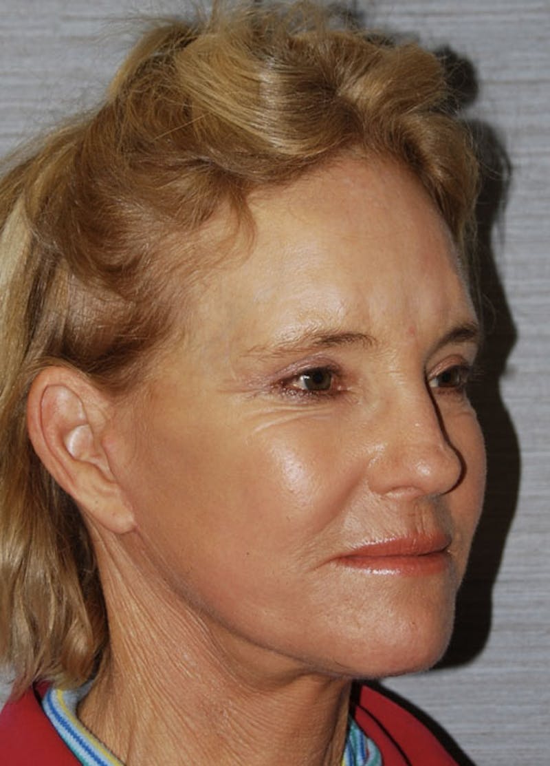 Facelift & Necklift Before & After Gallery - Patient 133024126 - Image 4