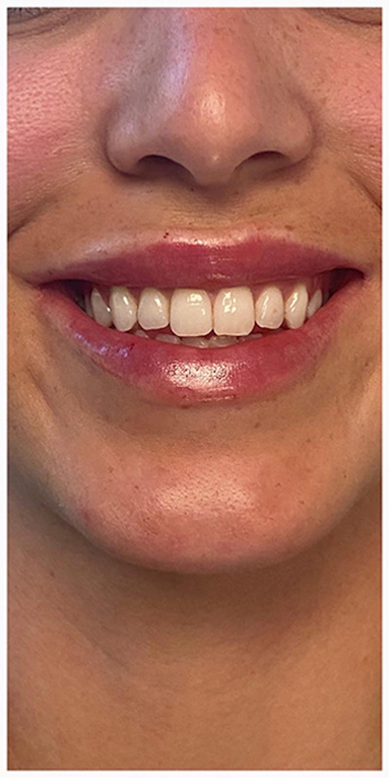 Lip Enhancement Before & After Gallery - Patient 133024127 - Image 10