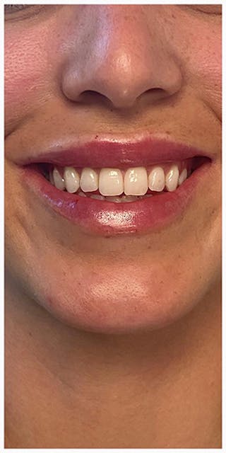 Lip Enhancement Before & After Gallery - Patient 133024127 - Image 10