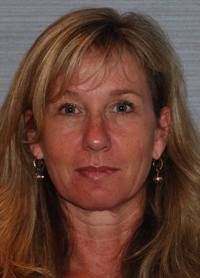 Facelift & Necklift Before & After Gallery - Patient 133024129 - Image 1