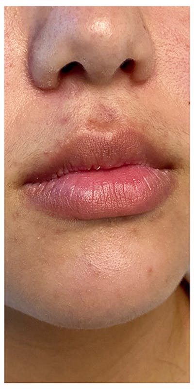 Lip Enhancement Before & After Gallery - Patient 133024132 - Image 1