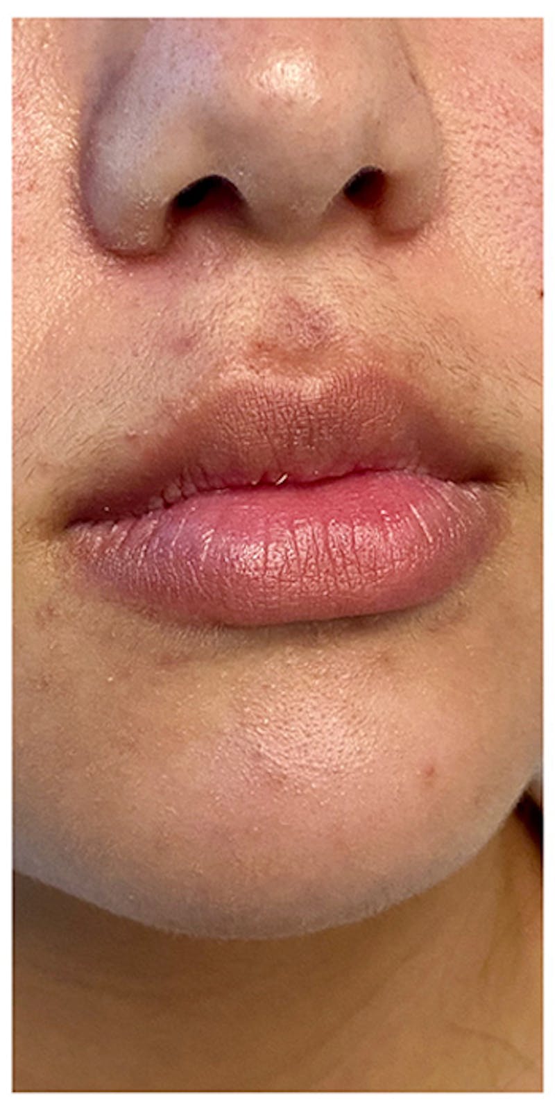 Lip Enhancement Before & After Gallery - Patient 133024132 - Image 1