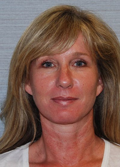 Facelift & Necklift Before & After Gallery - Patient 133024129 - Image 2
