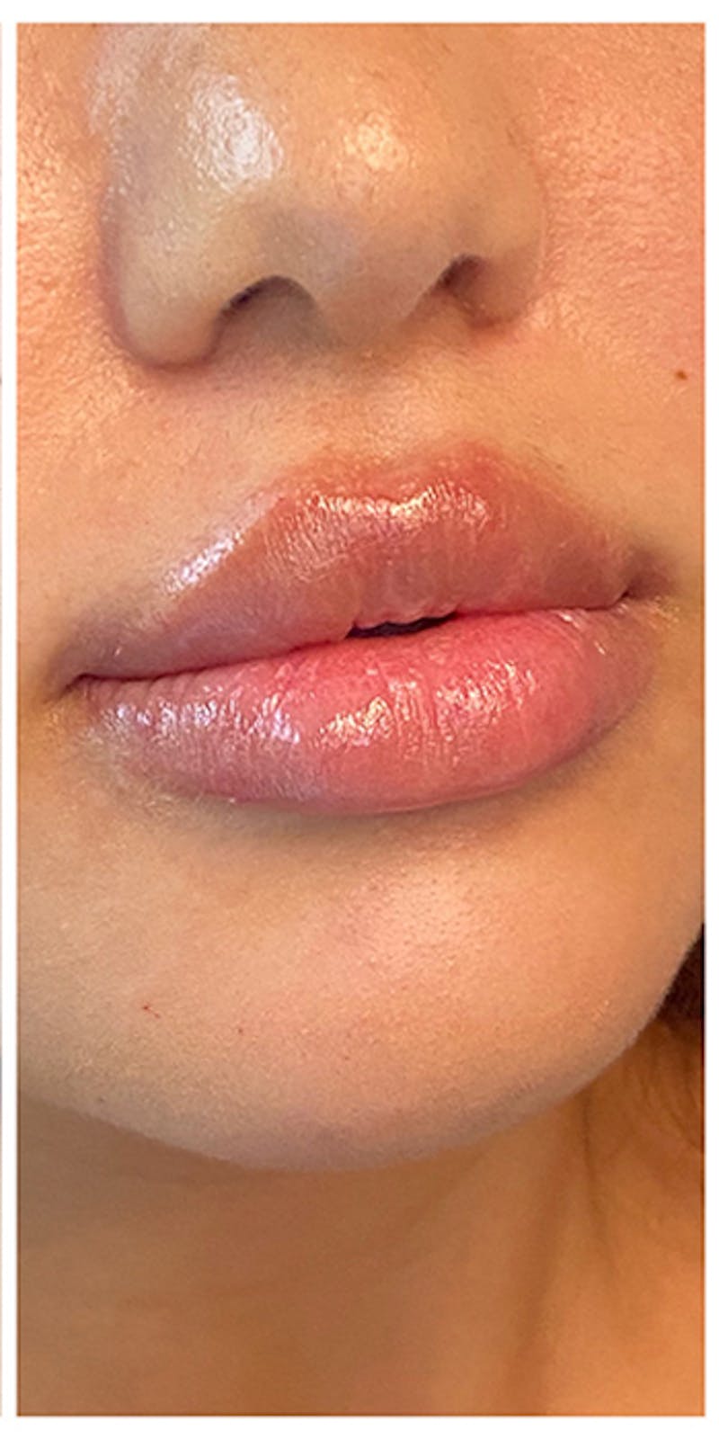 Lip Enhancement Before & After Gallery - Patient 133024132 - Image 2