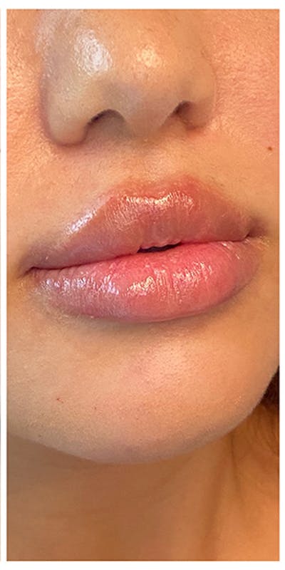 Lip Enhancement Before & After Gallery - Patient 133024132 - Image 2