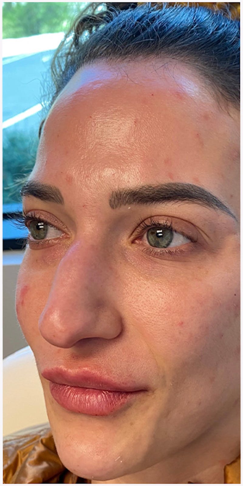 Dermal Fillers Before & After Gallery - Patient 133024133 - Image 4