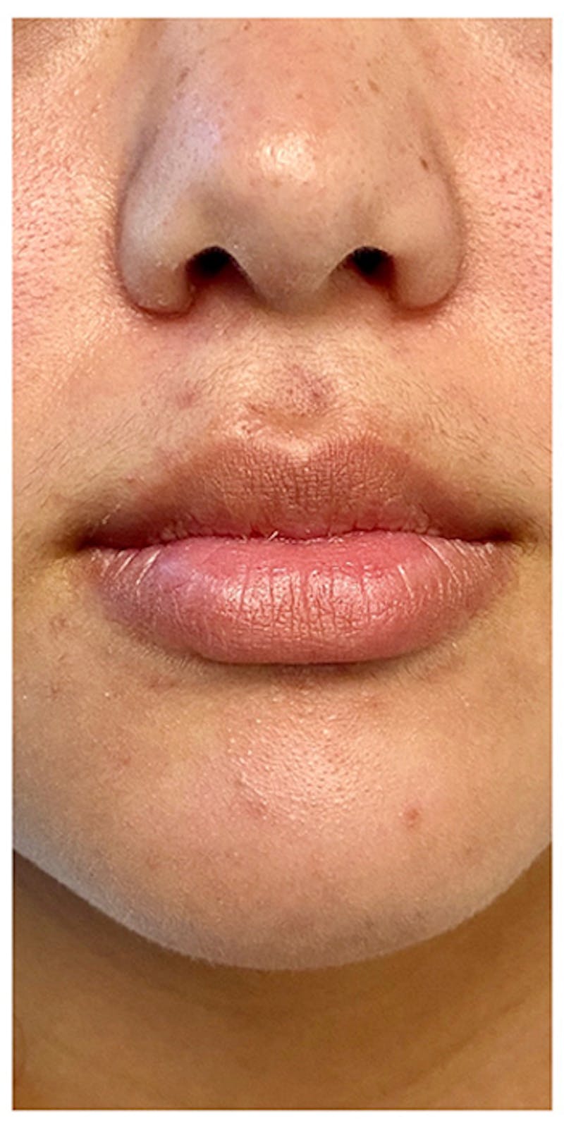 Lip Enhancement Before & After Gallery - Patient 133024132 - Image 3