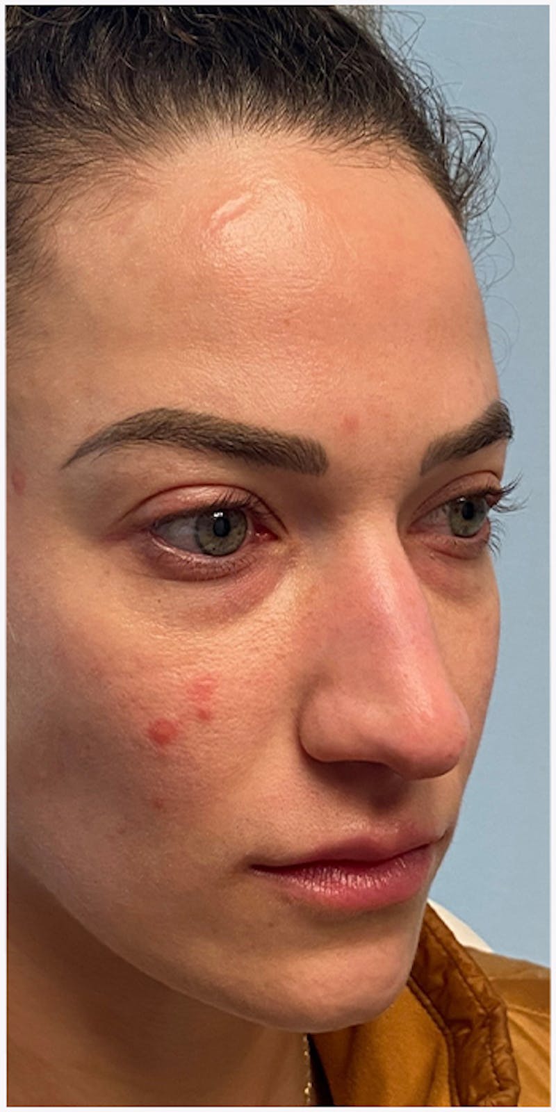 Dermal Fillers Before & After Gallery - Patient 133024133 - Image 5