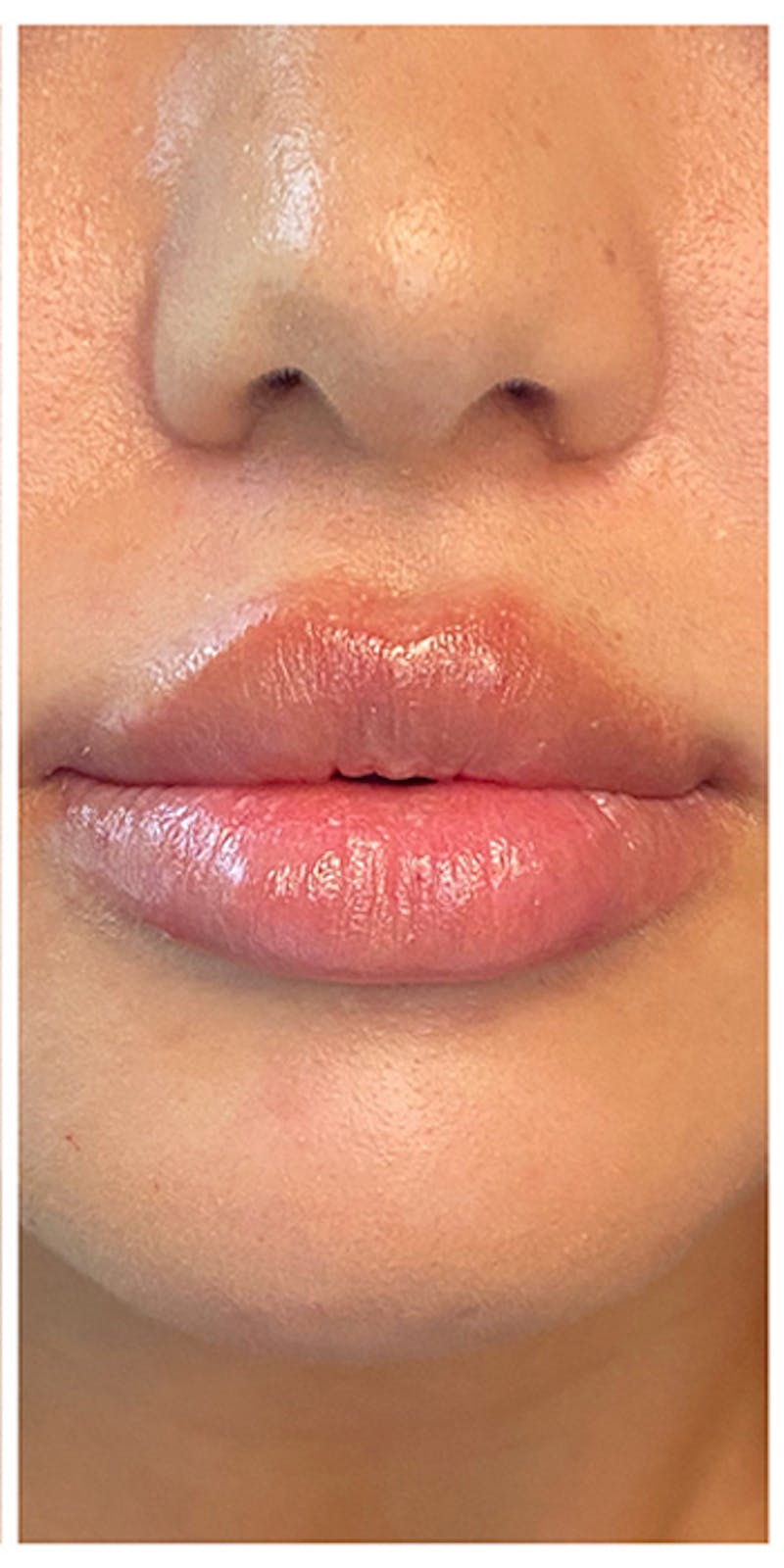 Lip Enhancement Before & After Gallery - Patient 133024132 - Image 4