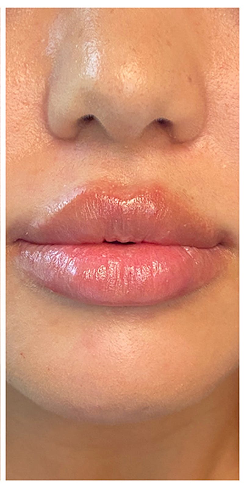 Lip Enhancement Before & After Gallery - Patient 133024132 - Image 4