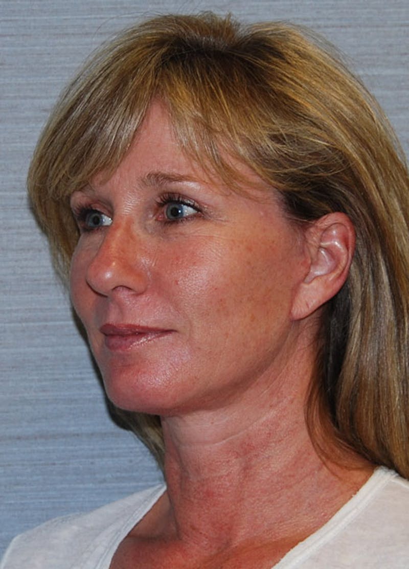 Facelift & Necklift Before & After Gallery - Patient 133024129 - Image 4