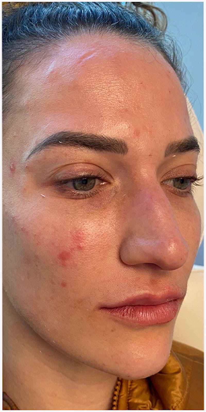 Dermal Fillers Before & After Gallery - Patient 133024133 - Image 6
