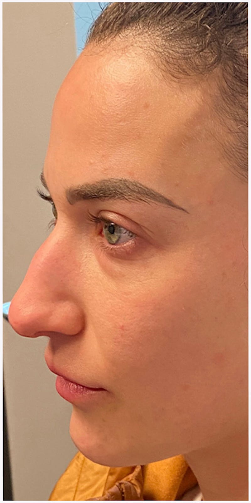 Dermal Fillers Before & After Gallery - Patient 133024133 - Image 7