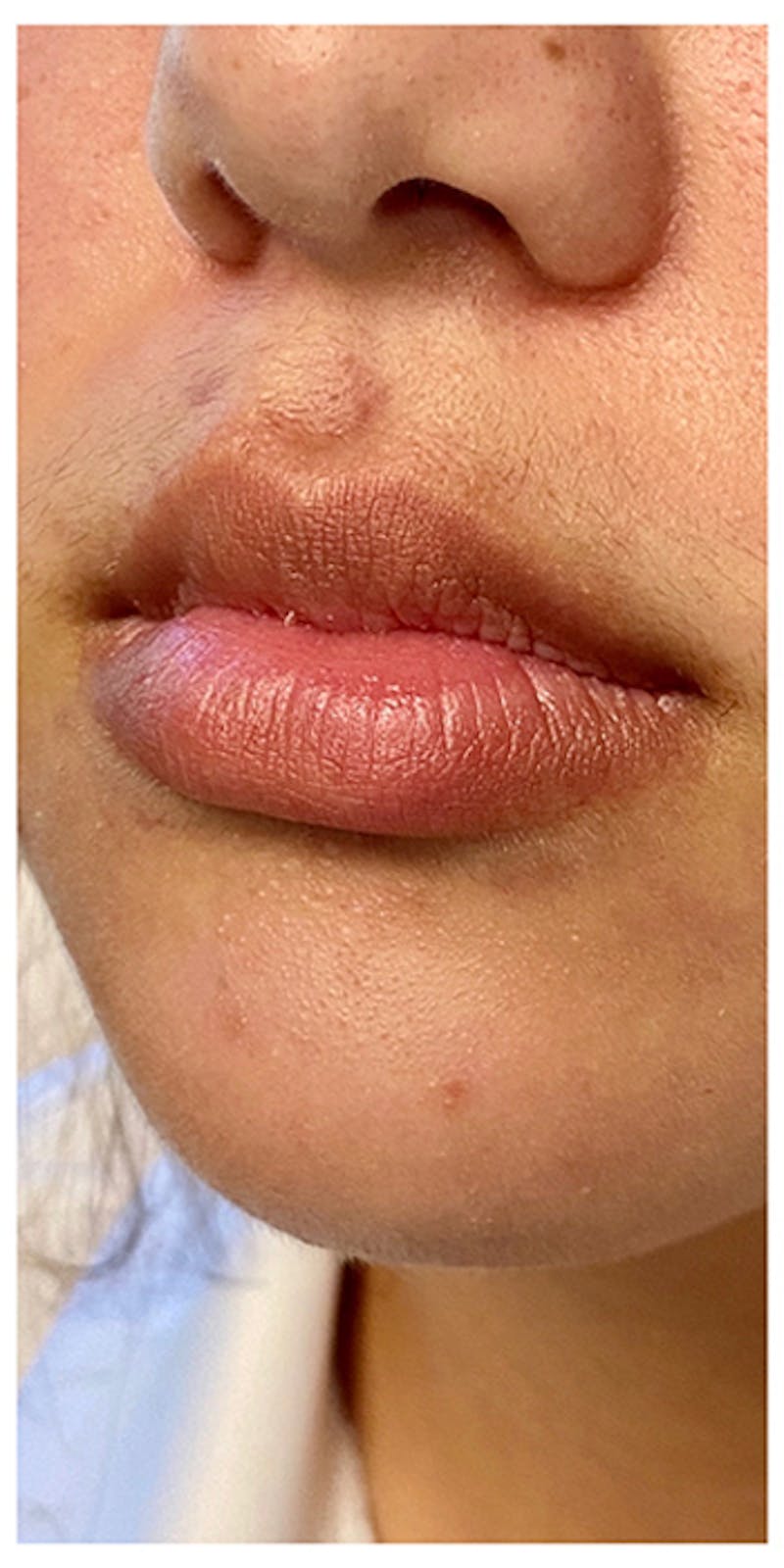 Lip Enhancement Before & After Gallery - Patient 133024132 - Image 5