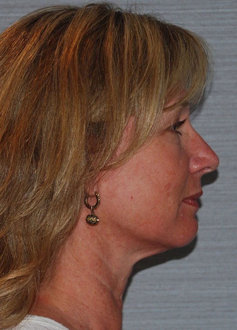 Facelift & Necklift Before & After Gallery - Patient 133024129 - Image 5