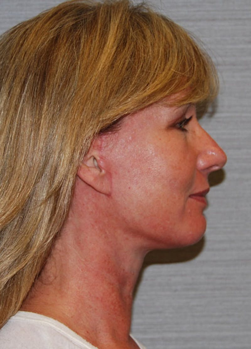 Facelift & Necklift Before & After Gallery - Patient 133024129 - Image 6