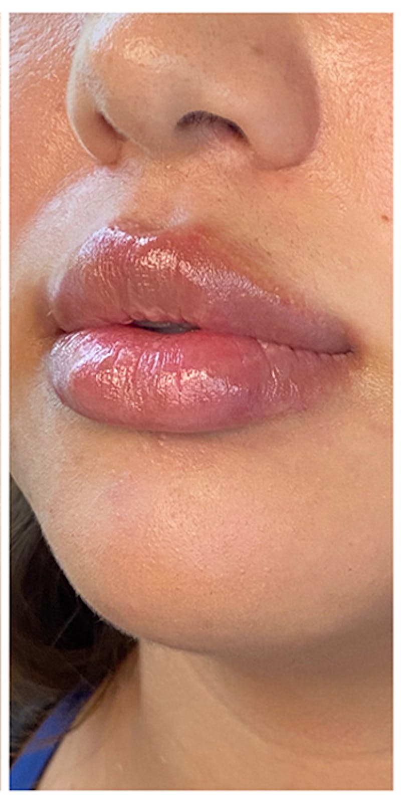 Lip Enhancement Before & After Gallery - Patient 133024132 - Image 6