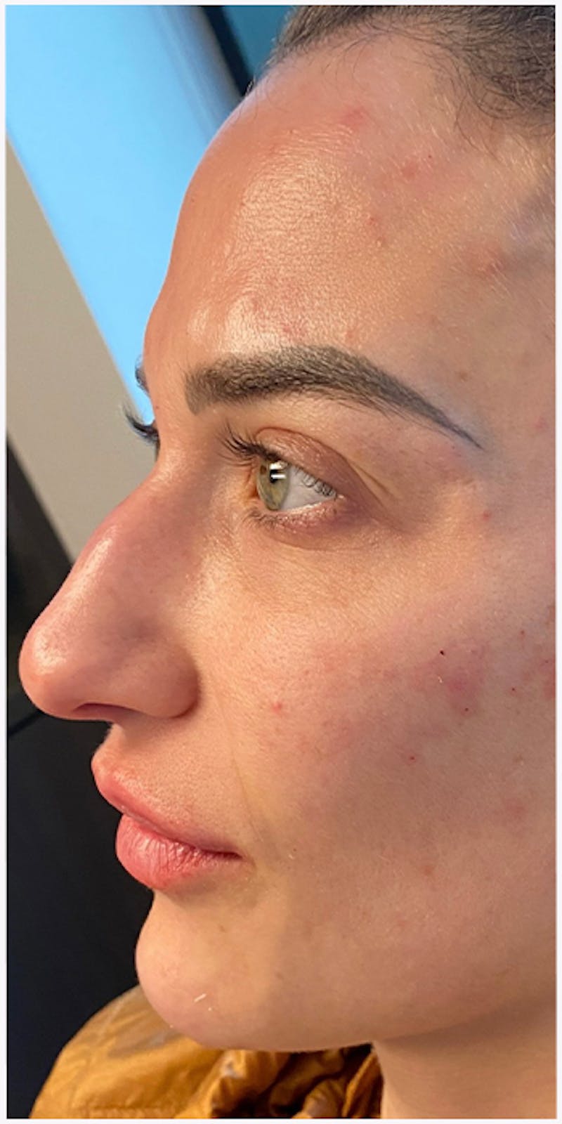 Dermal Fillers Before & After Gallery - Patient 133024133 - Image 8