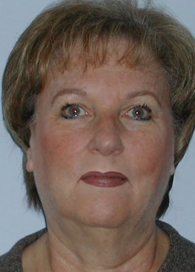 Facelift & Necklift Before & After Gallery - Patient 133024138 - Image 1