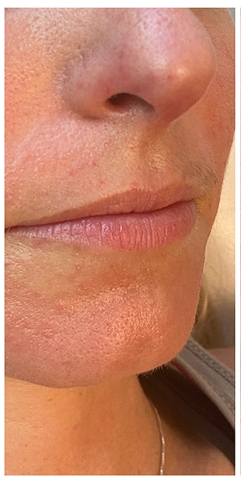 Lip Enhancement Before & After Gallery - Patient 133024141 - Image 1