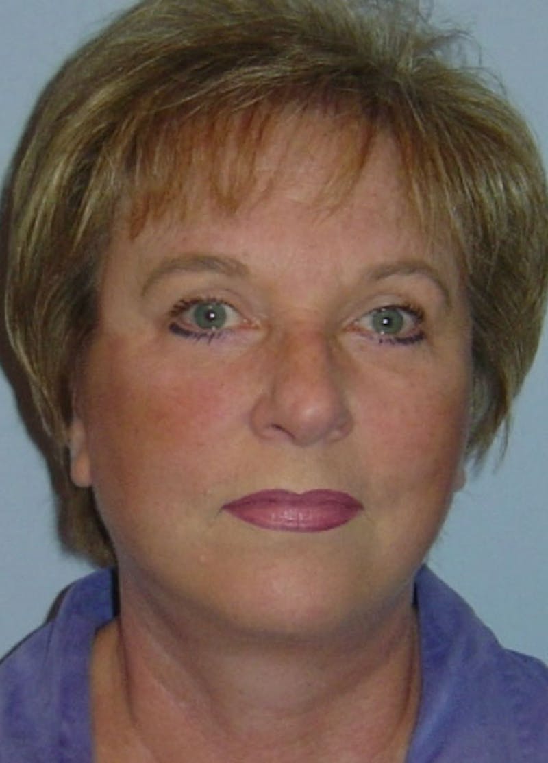 Facelift & Necklift Before & After Gallery - Patient 133024138 - Image 2