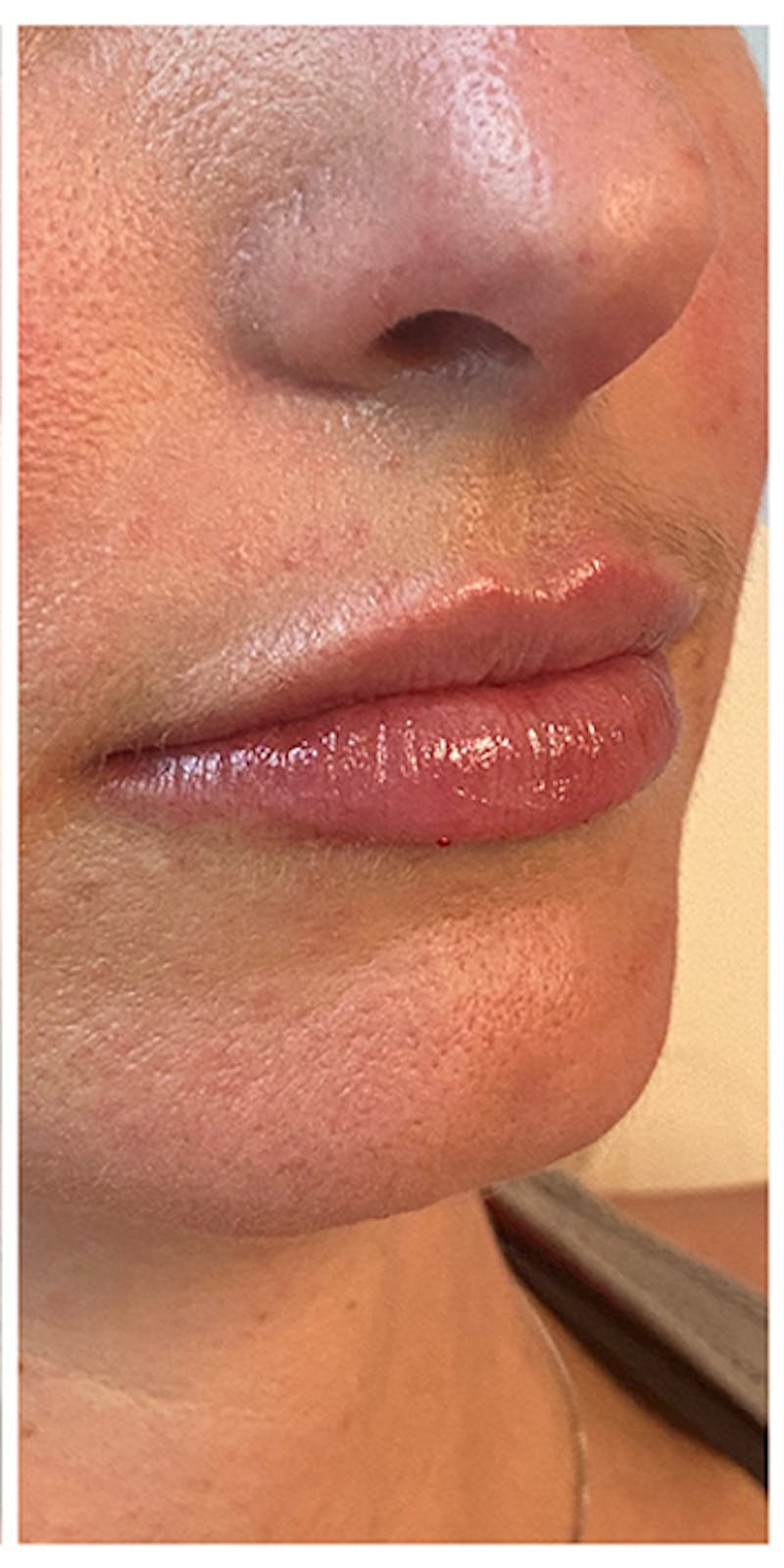 Lip Enhancement Before & After Gallery - Patient 133024141 - Image 2