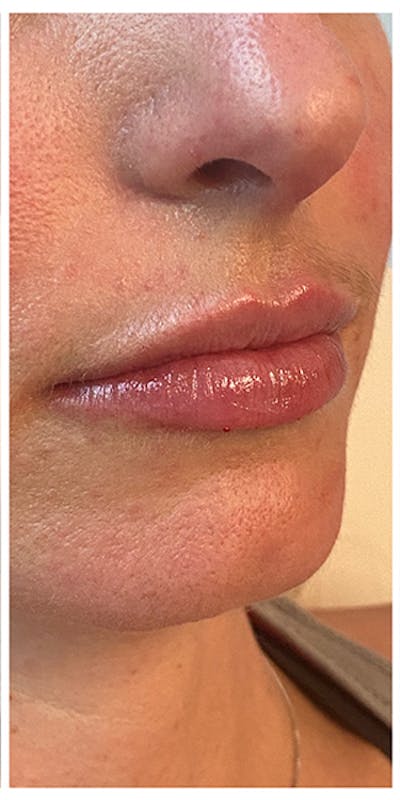 Lip Enhancement Before & After Gallery - Patient 133024141 - Image 2