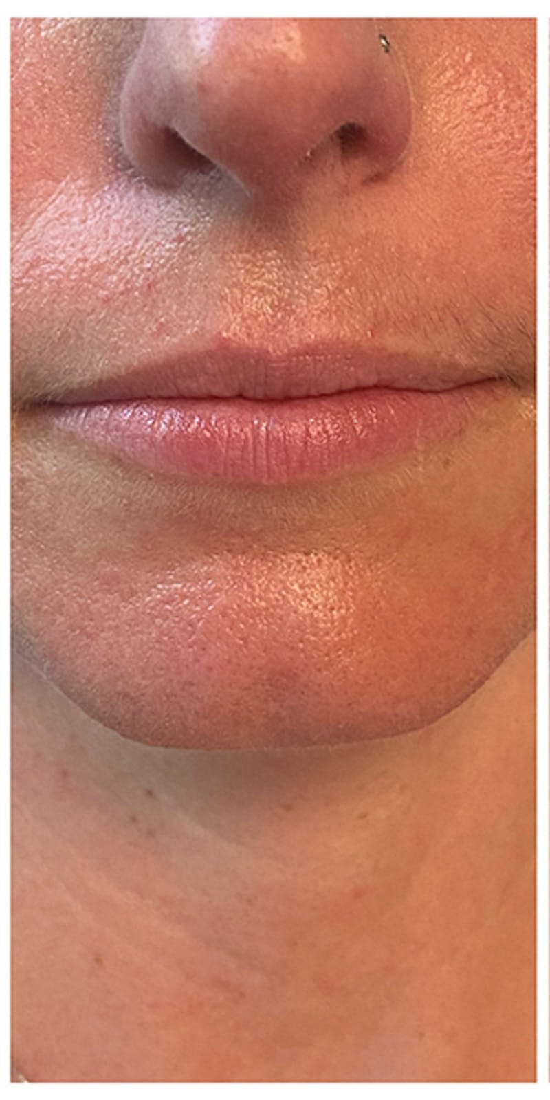Lip Enhancement Before & After Gallery - Patient 133024141 - Image 3
