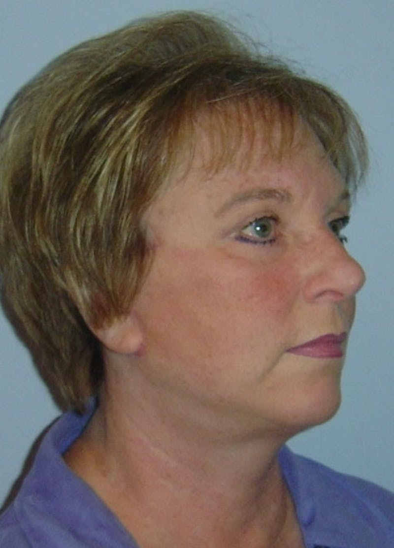 Facelift & Necklift Before & After Gallery - Patient 133024138 - Image 4