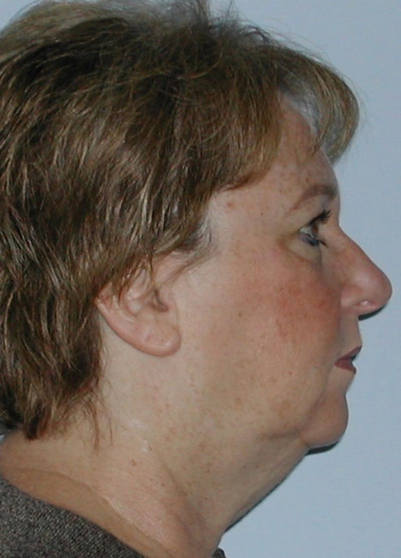 Facelift & Necklift Before & After Gallery - Patient 133024138 - Image 5