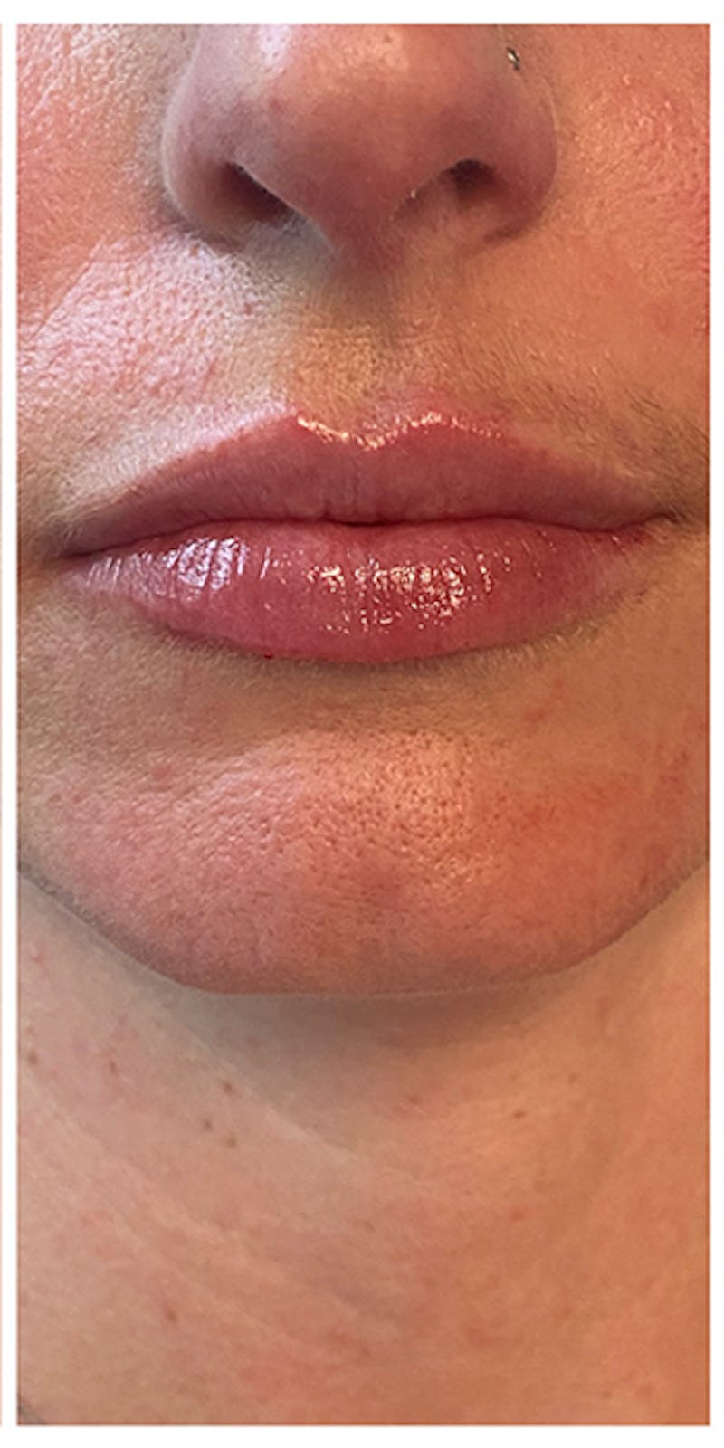 Lip Enhancement Before & After Gallery - Patient 133024141 - Image 4