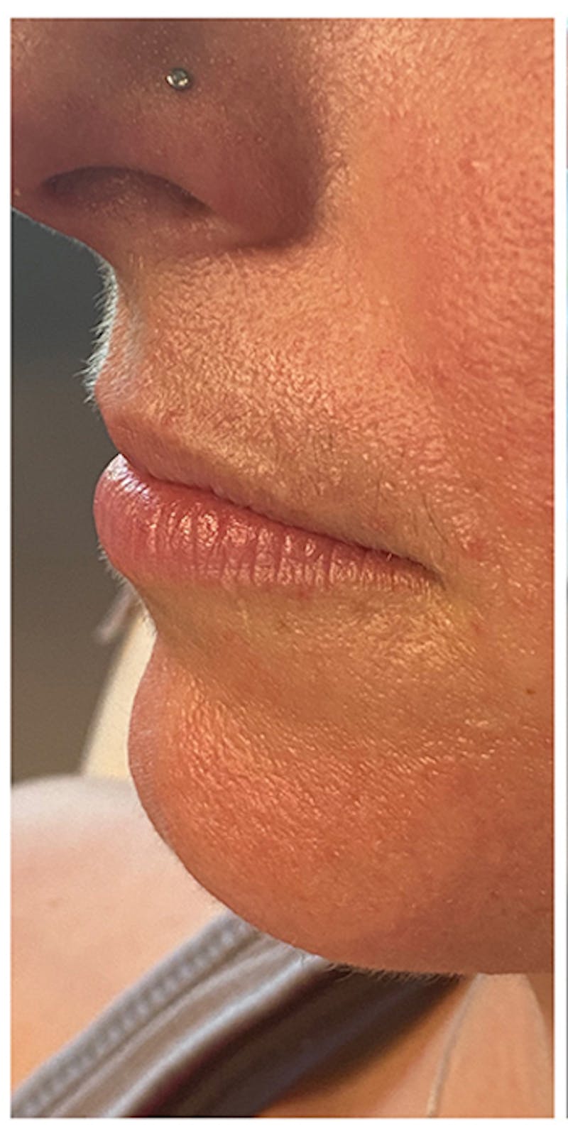 Lip Enhancement Before & After Gallery - Patient 133024141 - Image 5