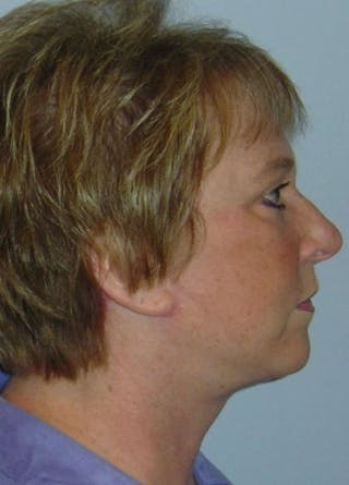 Facelift & Necklift Before & After Gallery - Patient 133024138 - Image 6