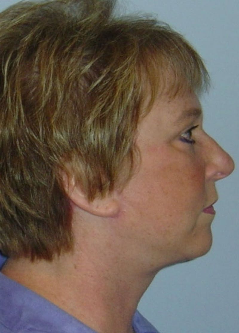 Facelift & Necklift Before & After Gallery - Patient 133024138 - Image 6